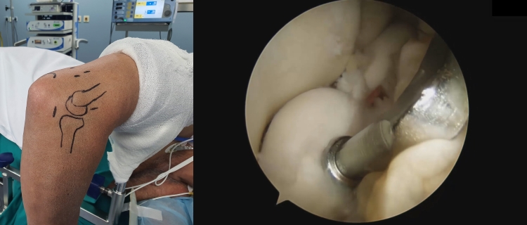 Chirurgia Elettiva Artroscopia T-SHEL