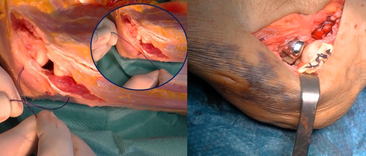 Chirurgia Elettiva Ligament reconstruction T-SHEL
