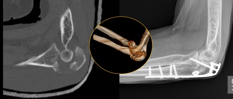 Gomito Ulna fractures T-SHEL